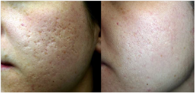 pimples scar reduction