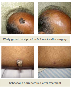 Treatment for Warty Lesions