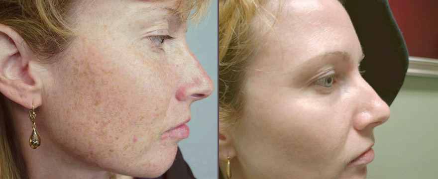 Skin laser treatment for pigmentation