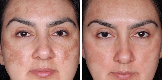 Skin laser treatment for pigmentation