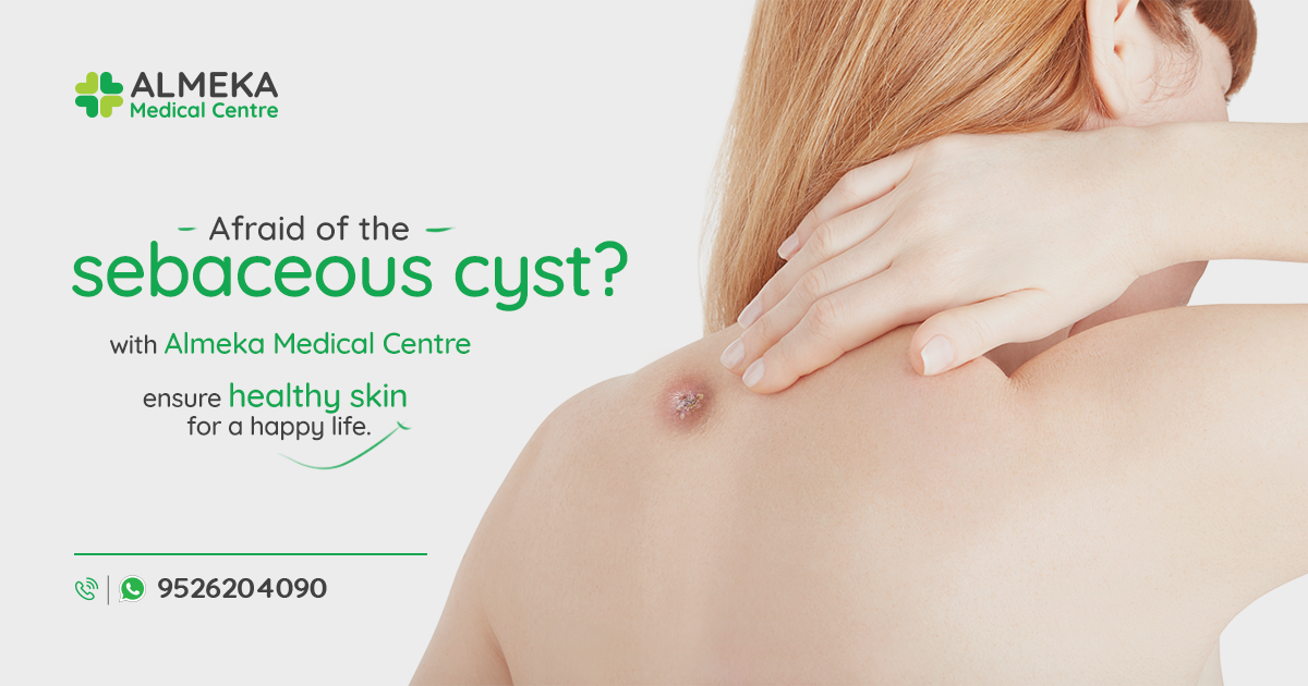 Afraid of the sebaceous cyst? AMC provides solution for this!