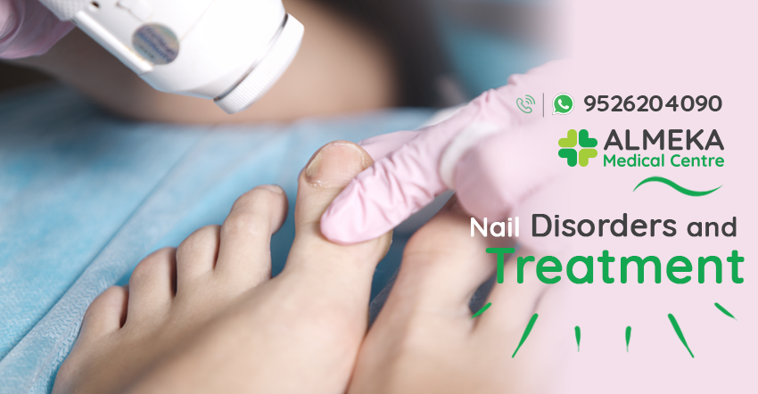 Nail Disorders Treatment in kochi  Almeka Medical Center