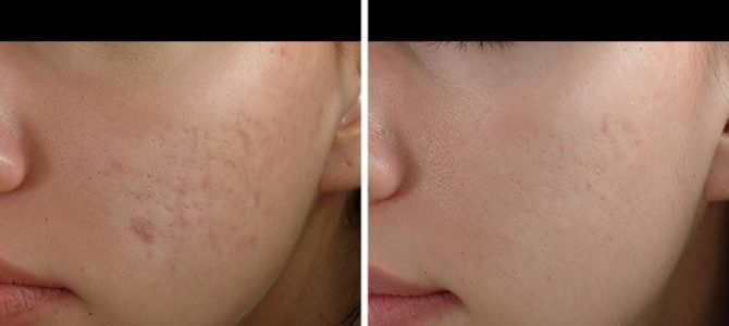 Rf subcision for acne scars